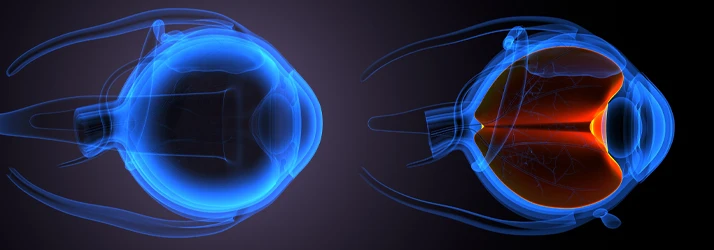 Side-by-side cross-sectional illustrations of eyes showing internal structures and highlighted light pathways.